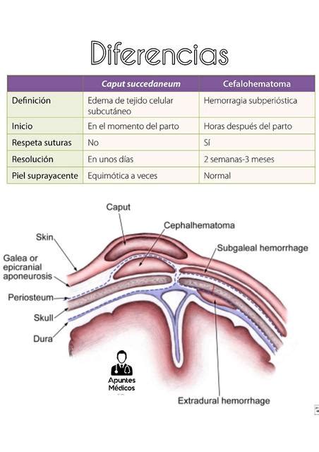 Caput Succedaneum Y Cefalohematoma Diferencias Apuntes M Dicos