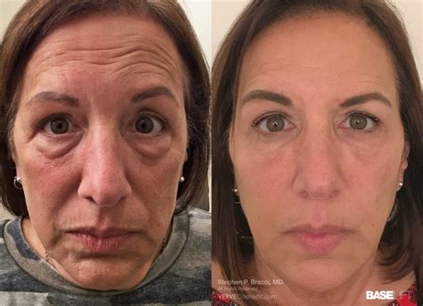 Before After Photos Of Non Surgical Facial Rejuvenation Contouring With