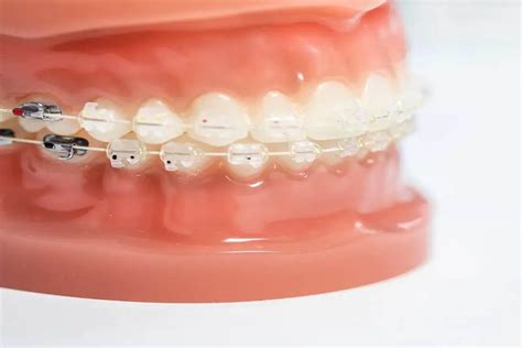 Los Brackets Clinica Dental Sonrisa Segura