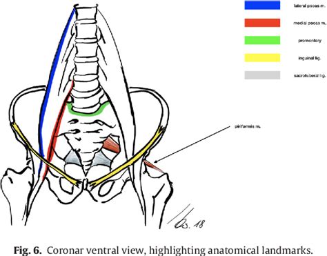 Figure From Laparoscopic Resection Of Retroperitoneal Intra Psoas