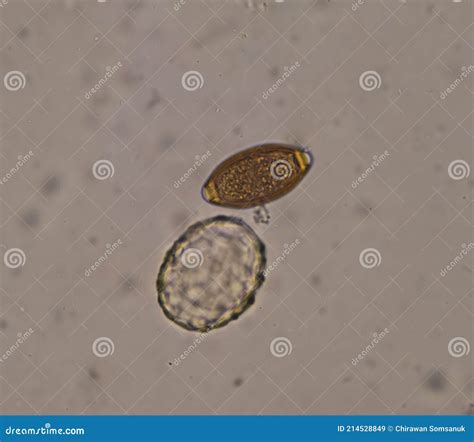 Mixed Ascaris Lumbricoides And Trichulis Trichiura Egg In Stool