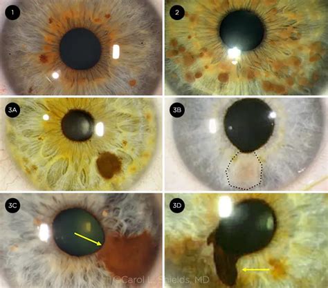 Differentiating Iris Pigmented Lesions A Primer American Academy Of