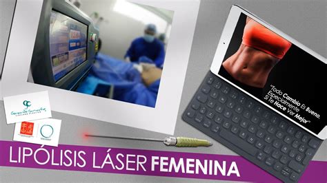 Lipolisis Laser Vaser Soring Laserlipolisis Liposuccion Dr