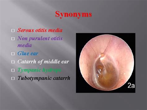 Otitis Media With Effusion Tuberculous Otitis Media Tympanosclerosis