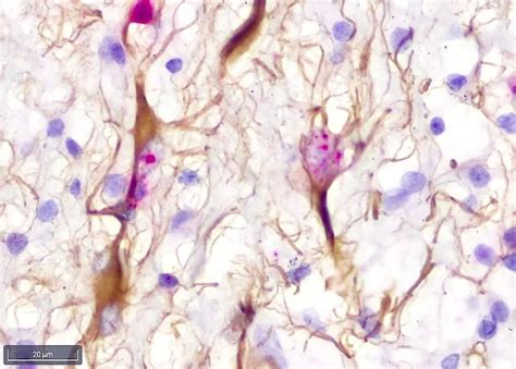 Pathologie Neuropathologie