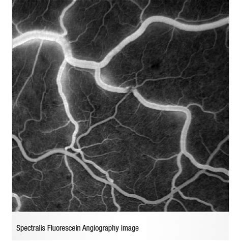 Heidelberg Spectralis Fluorescein Angiography Module Innova