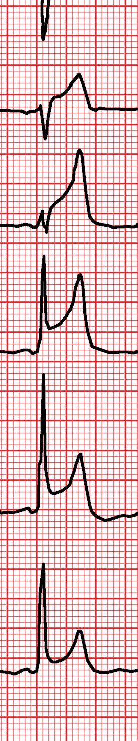 [cardio Fr] Stemi St Elevation Myocardial Infarction In The