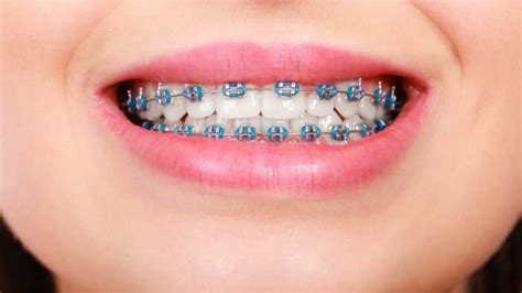 What do rubber bands do for braces and how important are they?