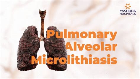 Pulmonary Alveolar Microlithiasis Pam Yashoda Hospitals Hyderabad