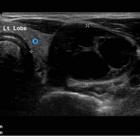 Ultrasonography Of The Thyroid Gland Revealing Left Lobe Of 36 X 20