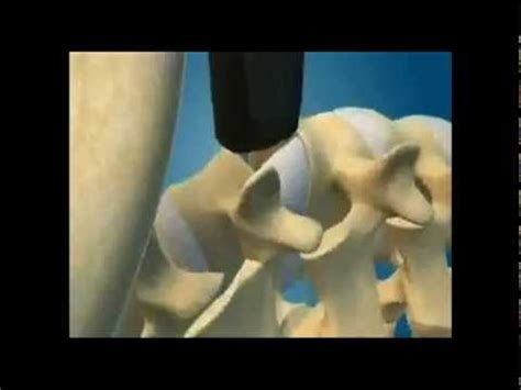 direct lateral interbody fusion animation youtube
