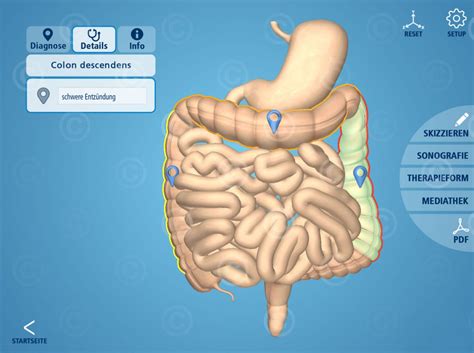 App Zu Chronisch Entz Ndlichen Darmerkrankungen Ced Medicalgraphics