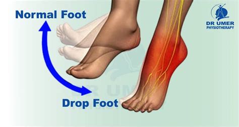 Foot Drop - Physiotherapy for Foot Drop