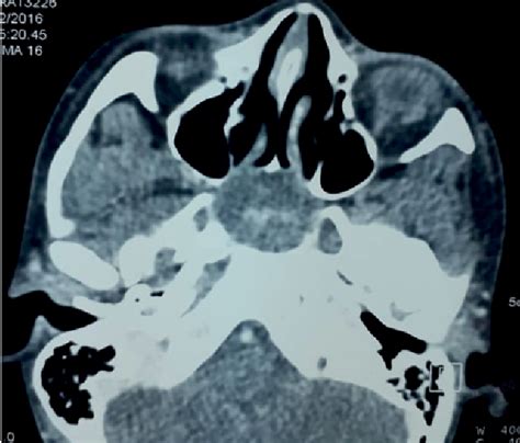 Figure From Capillary Hemangioma Of The Sphenoid Sinus Excision