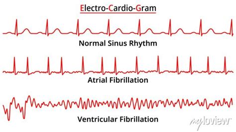 Set Of Ecg Common Abnormalities Atrial Fibrillation Ventricular