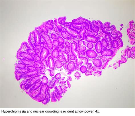 Pathology Outlines Tubular Adenoma