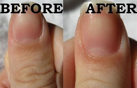 Stop Your Cuticle Skin From Peeling At Home Beauty Nails Cuticle