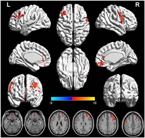 Frontiers Aberrant Structural And Functional Alterations In