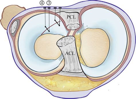 Final View After Examining The Lateral Meniscus The Thread Ends Are