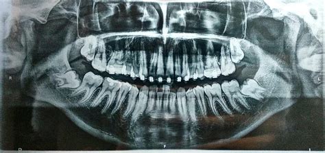 Are My Lower Wisdom Teeth Impacted X Rays Included Dentistry