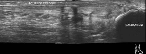 Achilles Tendon Tear Ultrasound