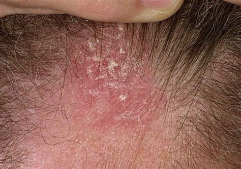 Tratamientos Efectivos Y Naturales Contra La Dermatitis Seborreica