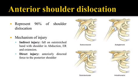 Shoulder dislocation | PPT