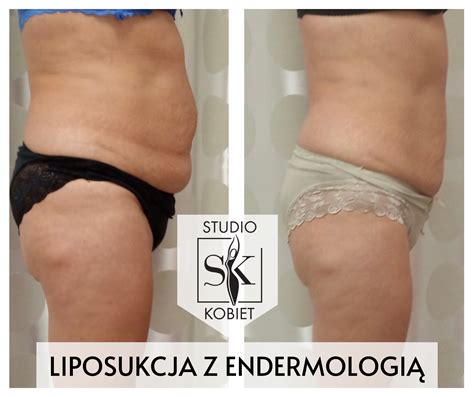 Endermologia Toru Usuwanie Cellulitu Modelowanie Sylwetki