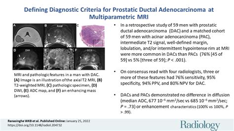 Defining Diagnostic Criteria For Prostatic Ductal Adenocarcinoma At Multiparametric Mri Radiology