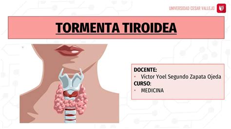 Tormenta Tiroidea MARYURI LISBETH UDocz