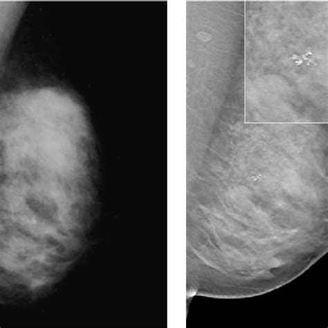 Example Tomosynthesis Original Mammography Left Slice From Download Scientific Diagram