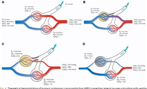 Hypoxic Pulmonary Vasoconstriction Physiology And Anesthetic