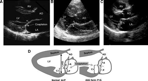 Epidemiology And Pathophysiology Of Mitral Valve Prolapse Circulation