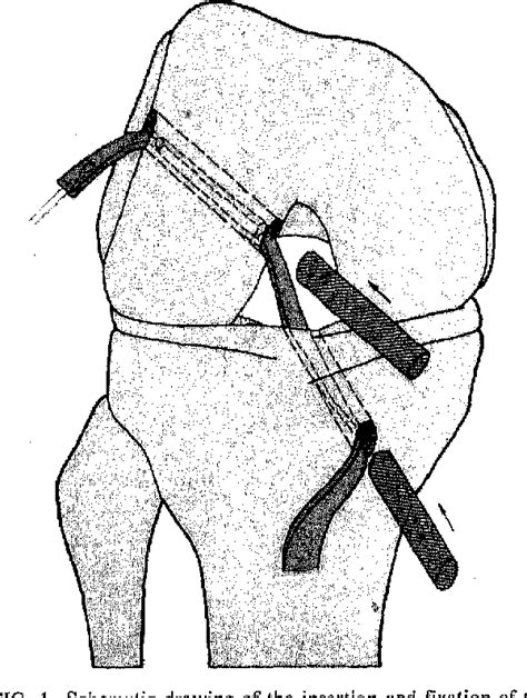 Figure 1 From Substitution Of The Anterior Cruciate Ligament A Long