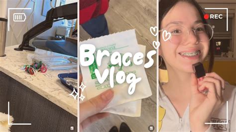 Braces Vlog Braces Update Youtube