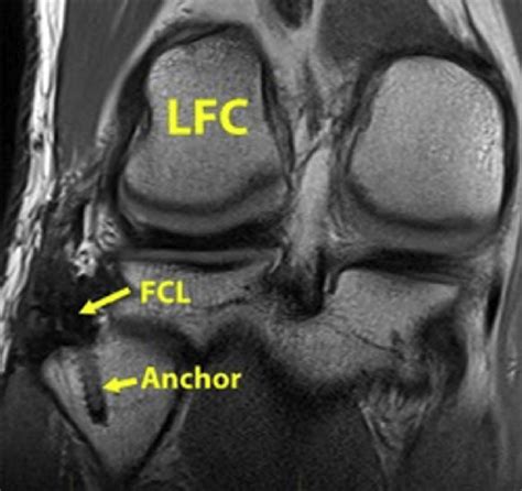 Magnetic Resonance Imaging Of A Right Knee Fatsuppressed Sequence On Download Scientific