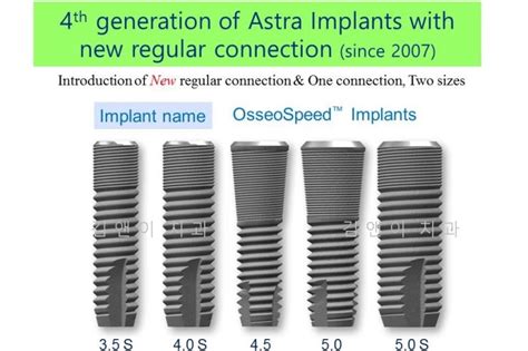 The Birth And Evolution Of Astra Implants아스트라 임플란트의 탄생과 진화 네이버 블로그