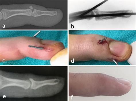 Mallet Finger Fracture Cpt at Mario Harrell blog