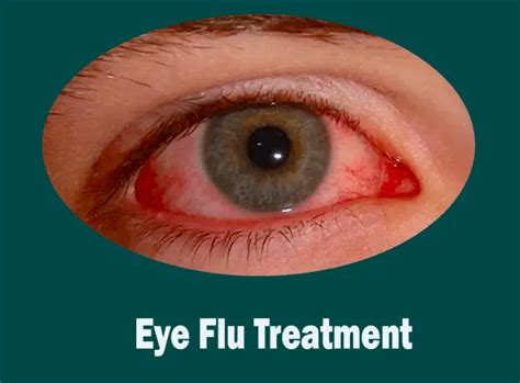 What is eye flu : Treatment, Symptoms, Medicine