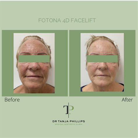 An In Depth Look Fotona D Facelift Dr Tanja Phillips Clinic