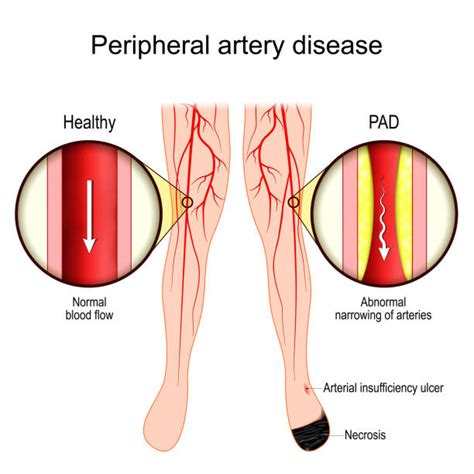 10 Peripheral Vascular Disease Illustrations Royalty Free Vector Graphics And Clip Art Istock