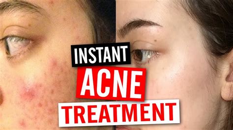 How To Get Rid Of Acne Instantly Youtube