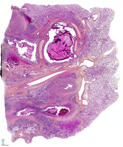 Cystic Fibrosis Human Pathology