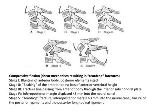 Cervical Spine Fractures And Injuries Classification