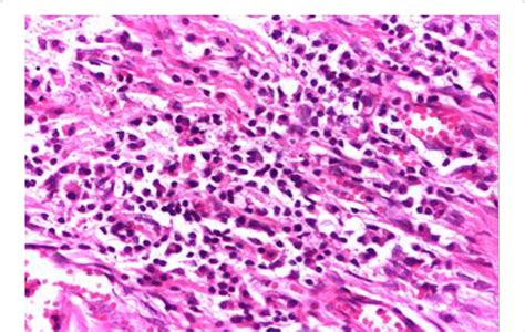 Microscopic Image In Plasma Cell Mastitis Inflammatory Infiltrate With