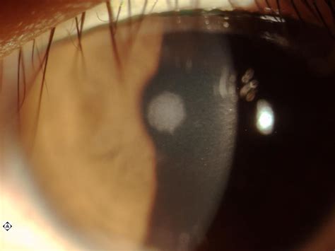 Sonoran Desert Eye Center: SCAR ON CORNEA FROM ULCER RELATING FROM CONTACT LENS OVERWEAR