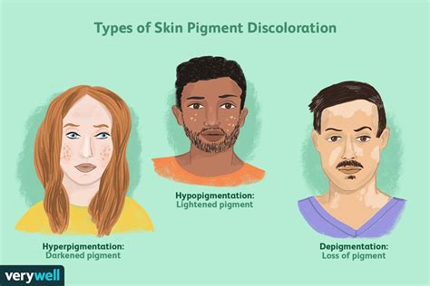 Skin Pigmentation: Causes, Disorders, Treatment