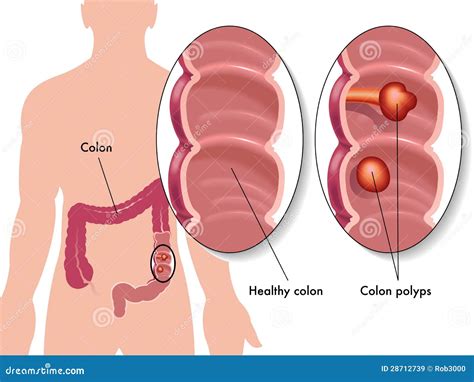 Polyps Pictures