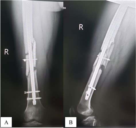 Immediate Postoperative Radiographs Of The Femur Anteroposterior A