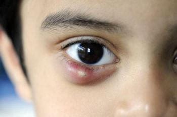 Symptoms and Diagnosis of Chalazion